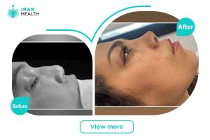 Revision Rhinoplasty before and after photos