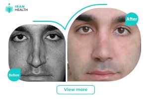 Revision Rhinoplasty before and after photos