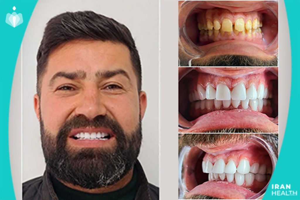 Tooth Whitening in Iran !? Why Iran While I Can Have it in my Hometown? | Iran Health Agency