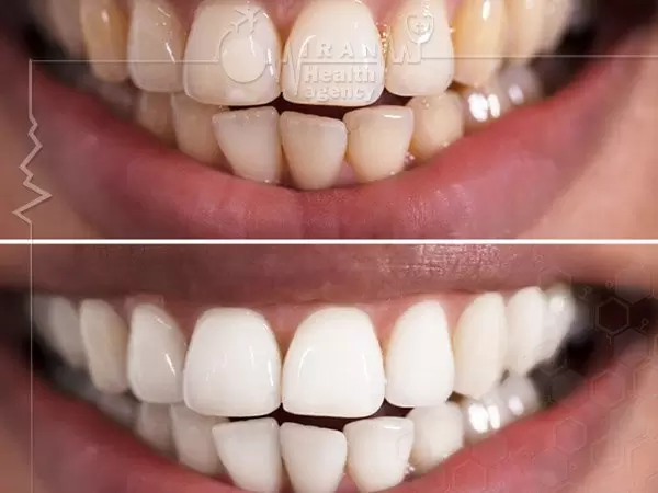 Tooth Bleaching in Iran