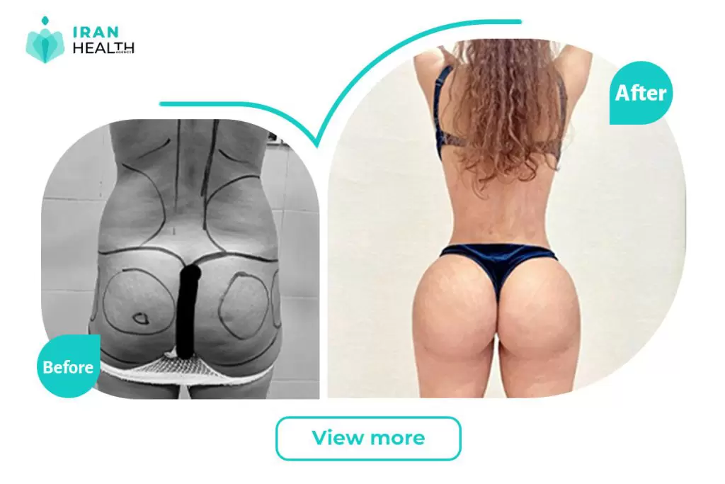 Brazilian Butt Lift in iran before after photos Brazilian Butt Lift in iran before after photos