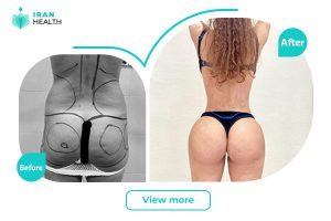 Brazilian Butt Lift in iran before after photos