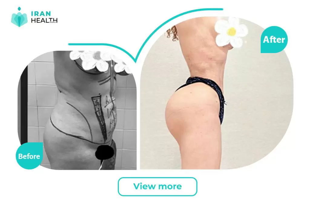 Brazilian Butt Lift in iran before after photos Brazilian Butt Lift in iran before after photos