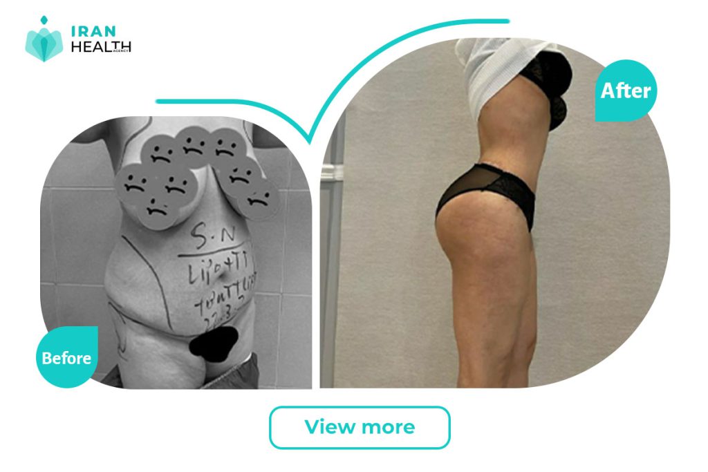 Brazilian Butt Lift in iran before after photos | iran health agency