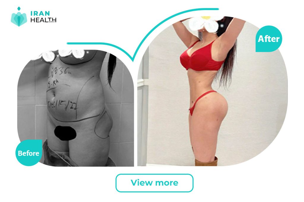 Brazilian Butt Lift in iran before after photos | iran health agency