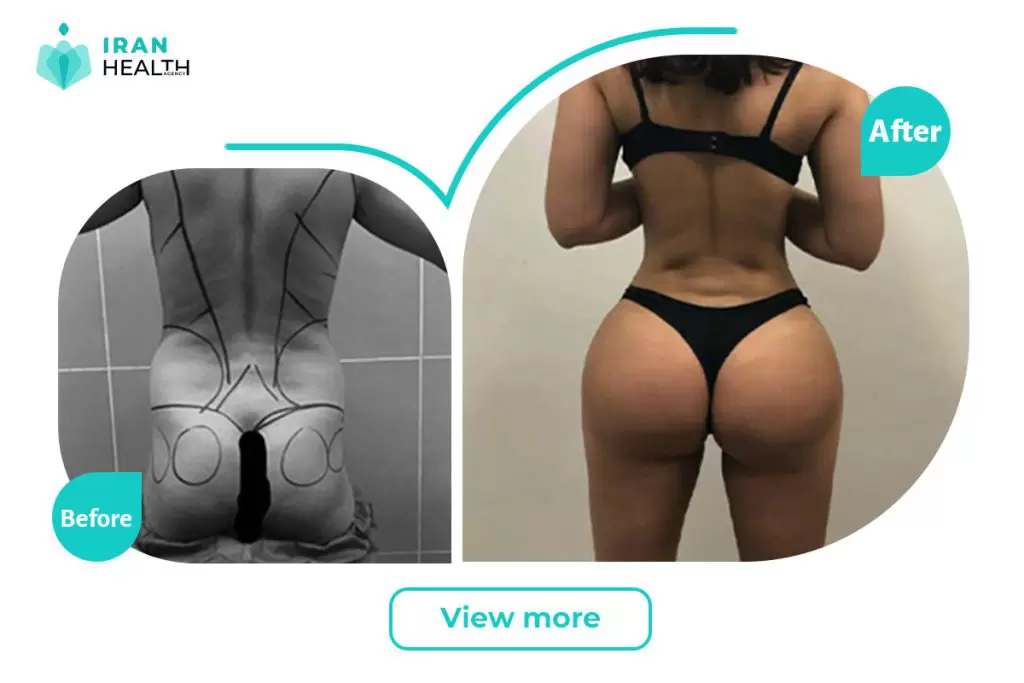 Brazilian Butt Lift in iran before after photos | iran health agency