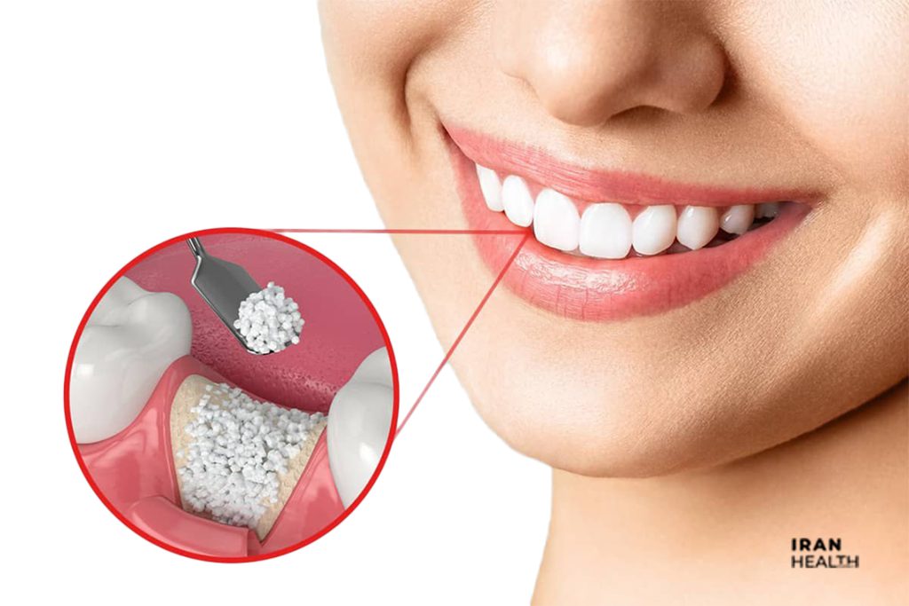 dental implant in iran iranhealthagency 4
