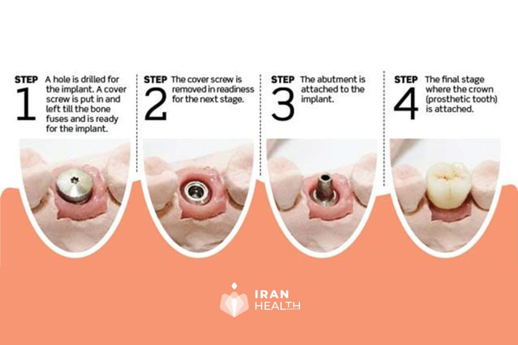 During Tooth Implants | iran health agency