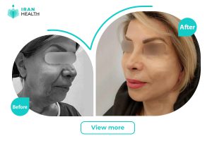 Facelift in Iran before and after