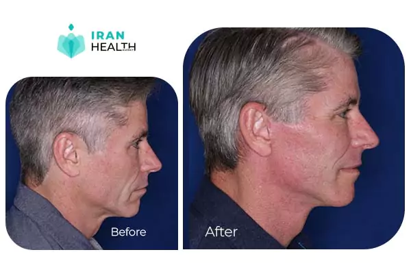 man facelift before after