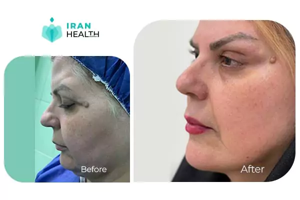 sideview facelift before after photos