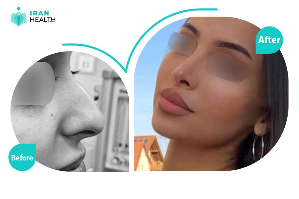 nose surgery before after photos