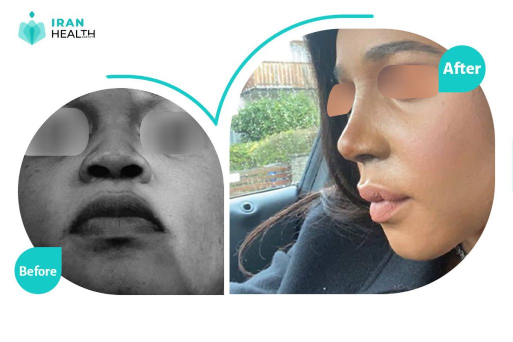 rhinoplasty before after photos in iran