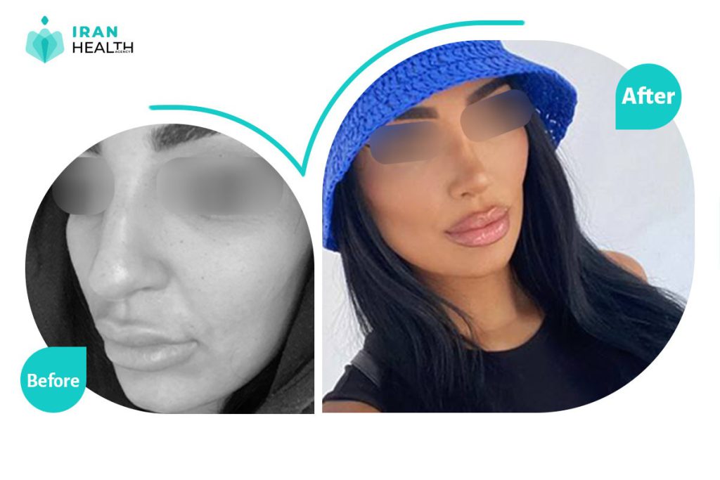 rhinoplasty surgery in iran before after photos