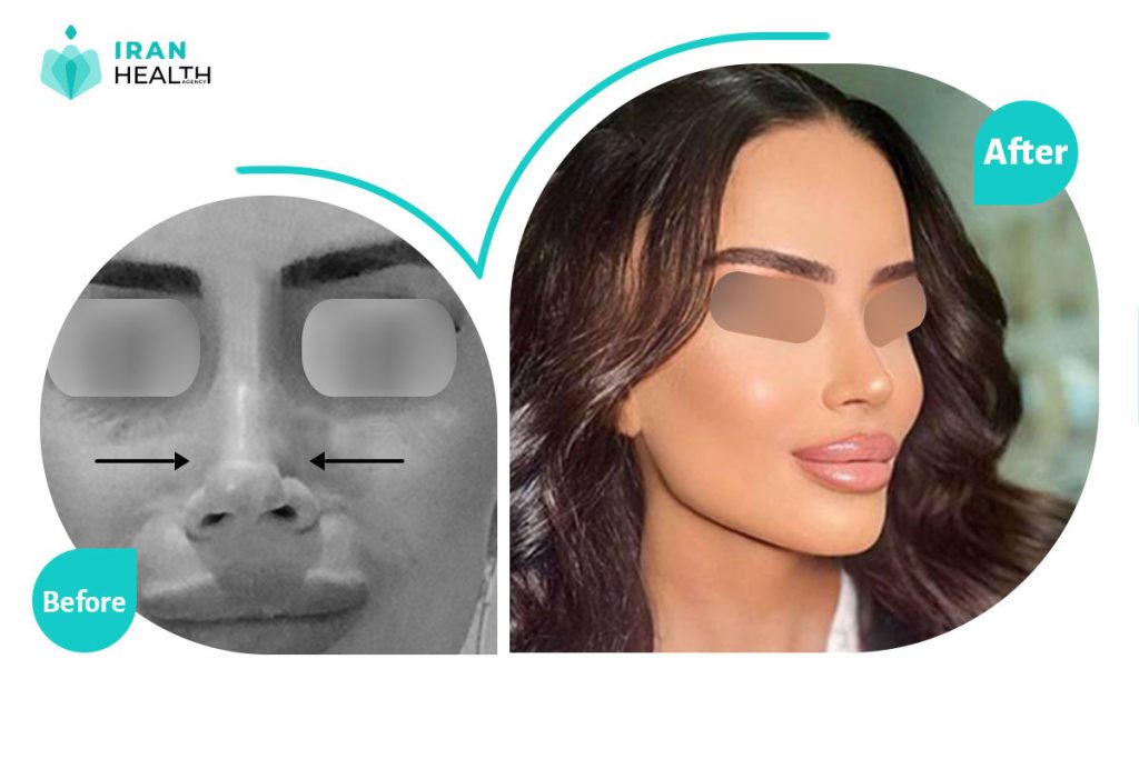 plastic surgery(rhinoplasty) before after photos