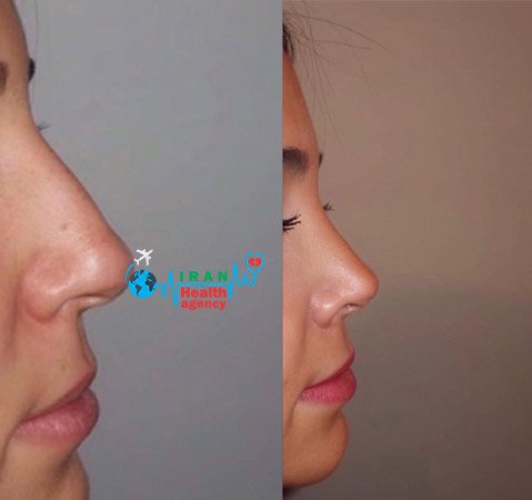 rhinoplasty in shiraz before and after | iranhealthagency