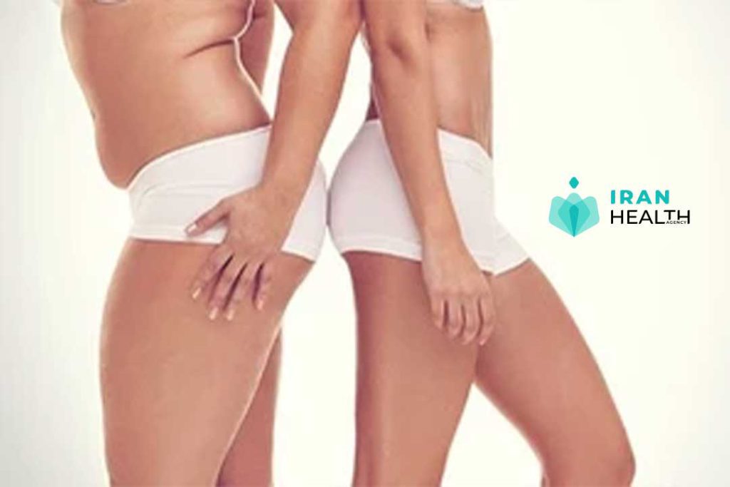 What is Tight Liposuction?
