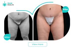 Abdominoplasty in iran before after photos