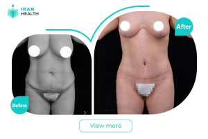 Abdominoplasty in iran before after photos
