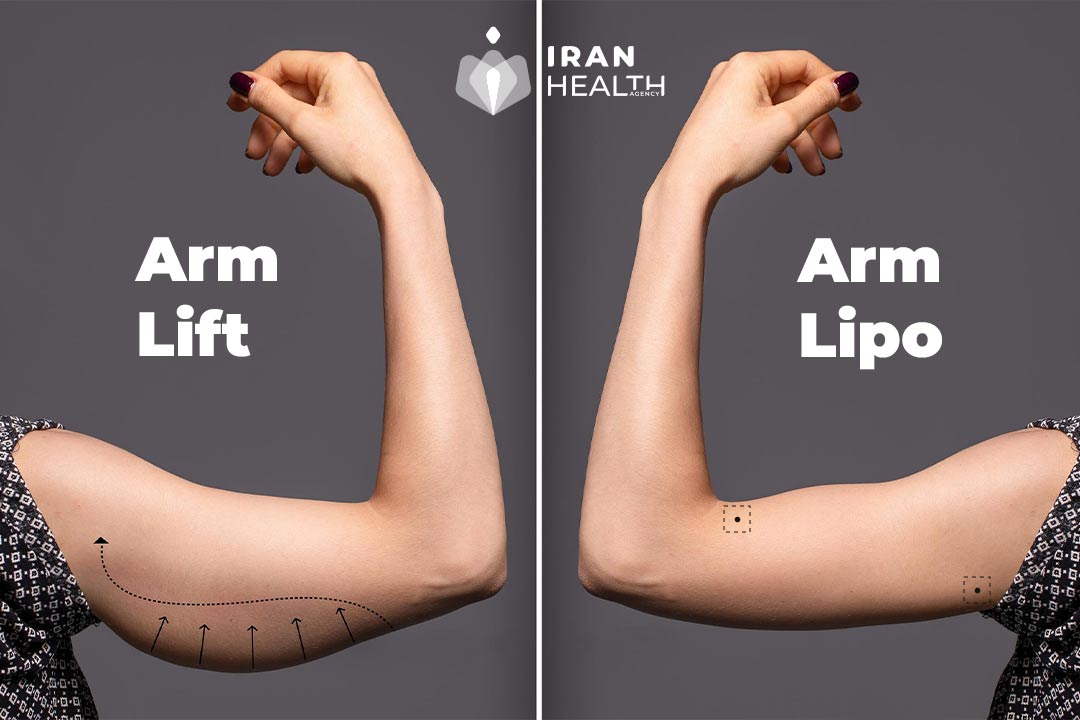 Which is better arm lift or arm lipo?