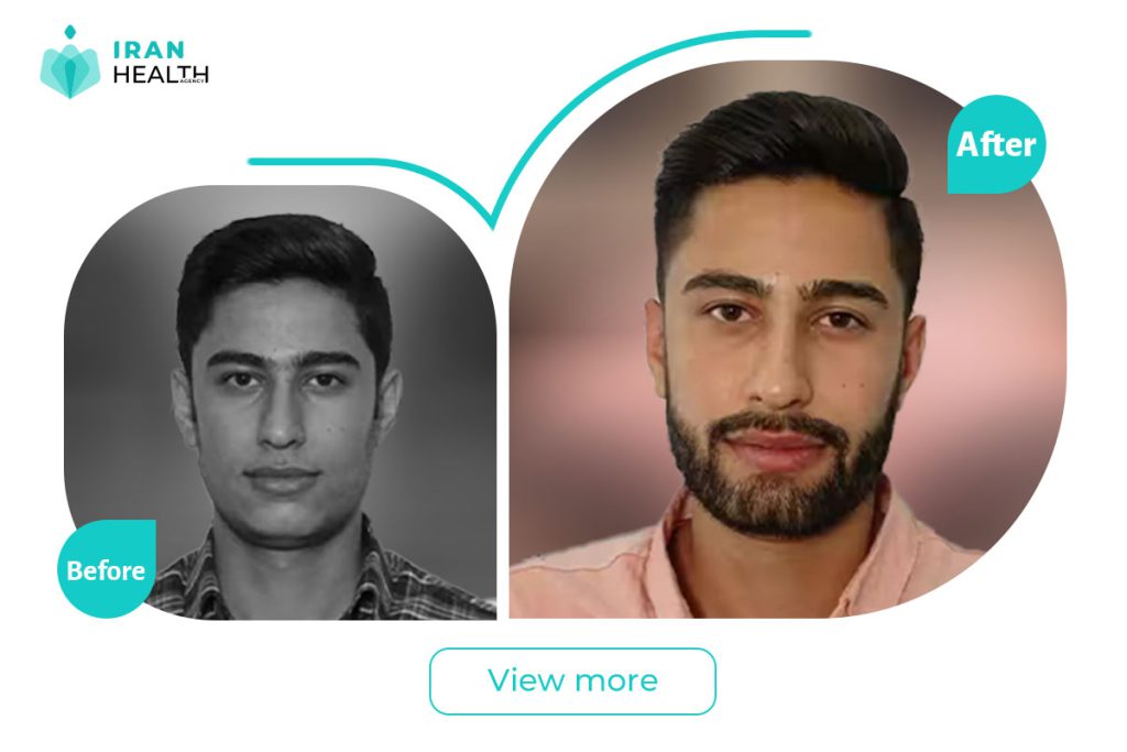Beard transplant in iran before after photos