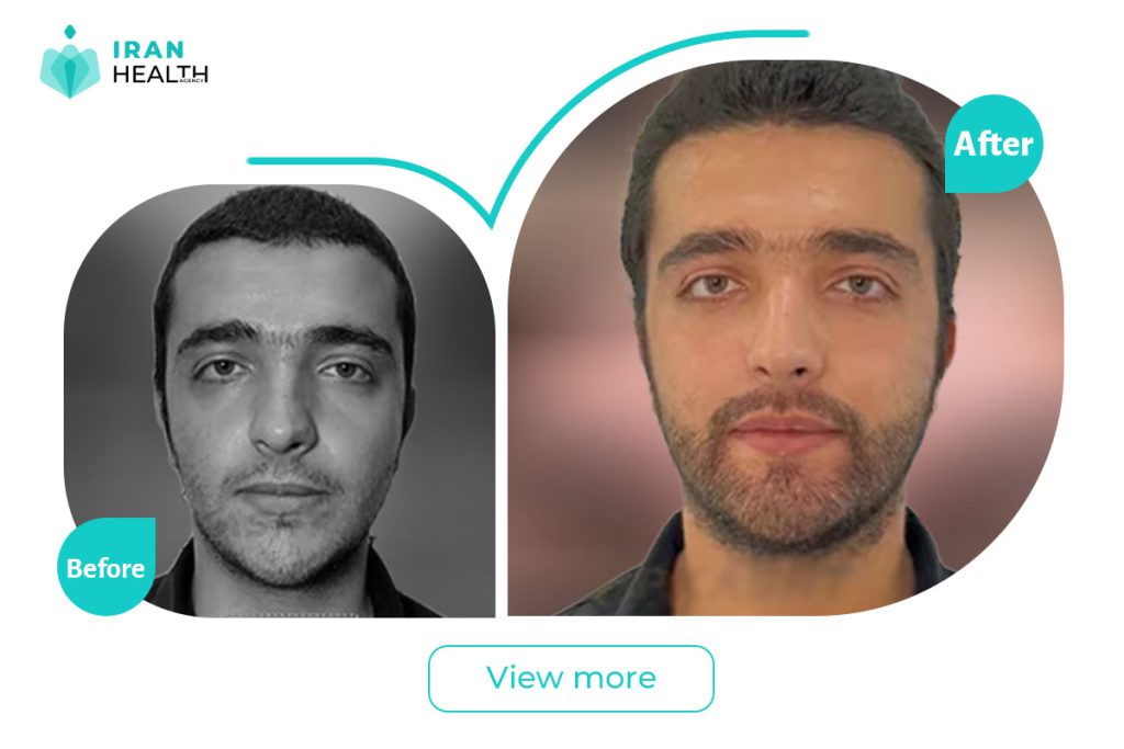 Beard transplant in iran before after photos