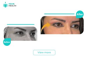 Blepharoplasty in iran before after photos