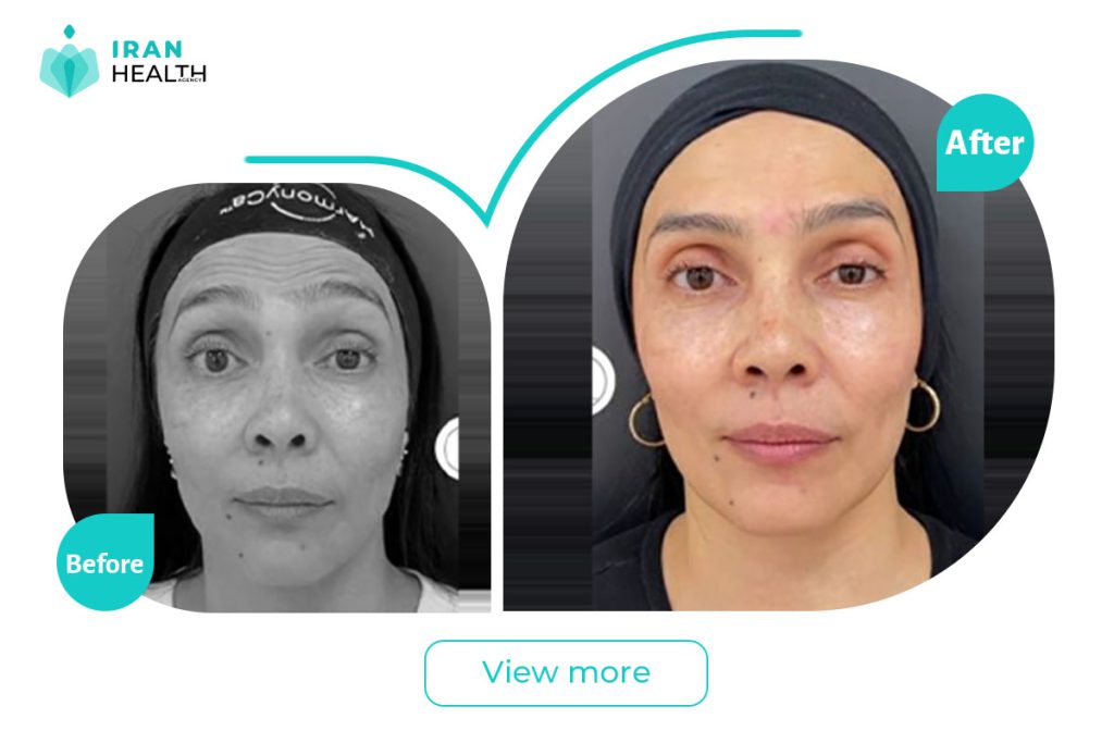Botox in iran before after photos