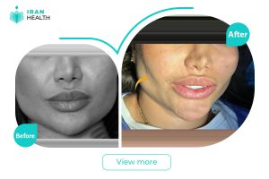 Buccal fat removal in Iran before after photos