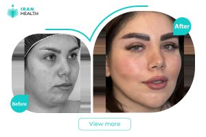 Cheek Reduction in Iran before after photos