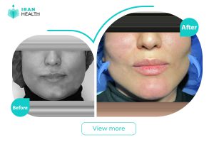 Buccal fat removal in Iran before after photos