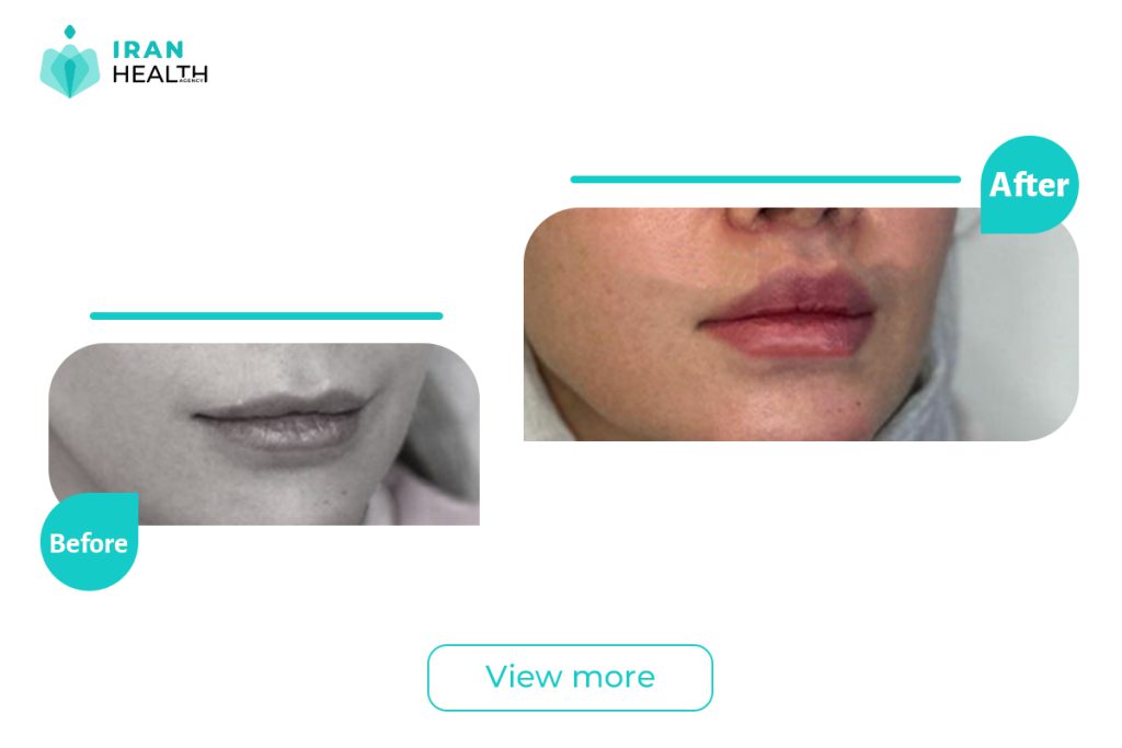 Central lip in iran before after photos