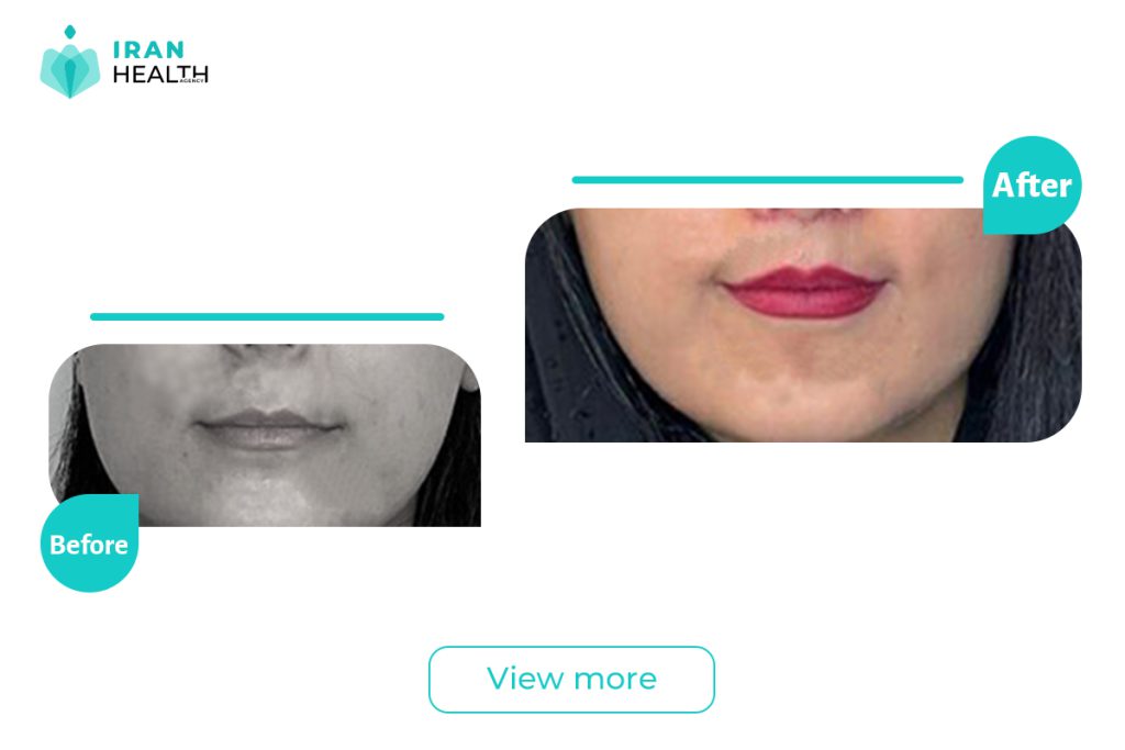 Central lip in iran before after photos