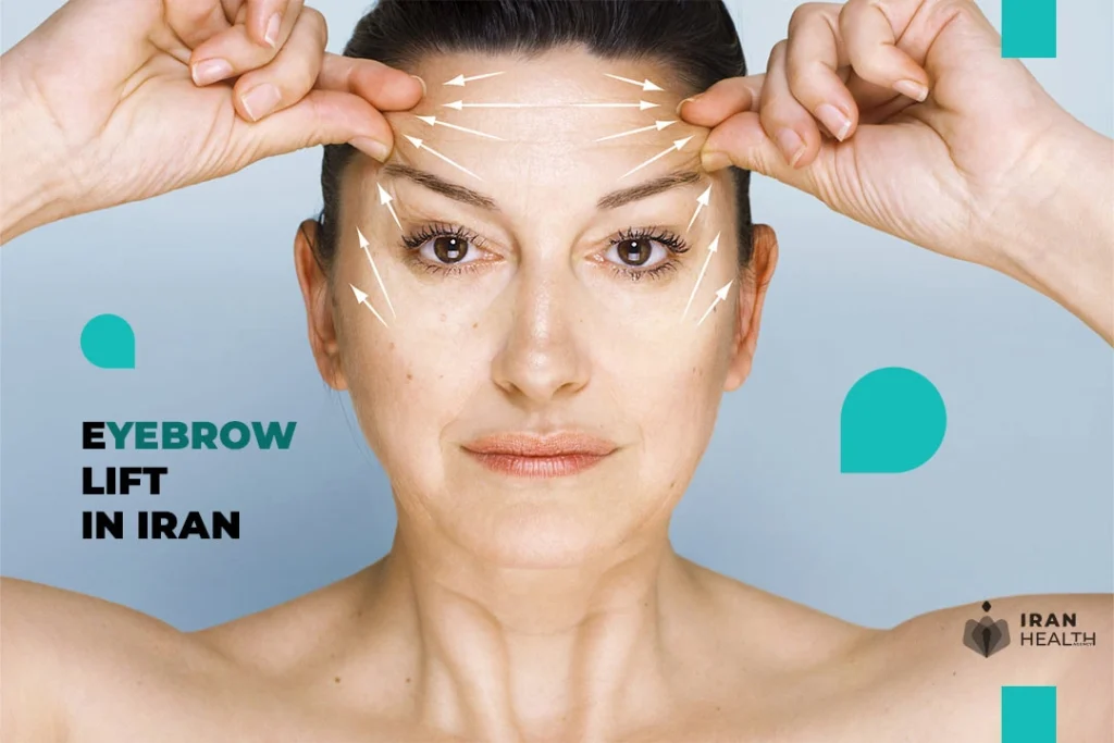 What is an eyebrow lift in Iran?