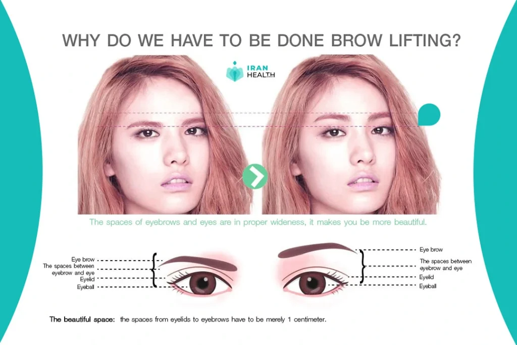 Who is suitable for eyebrow lift in Iran?