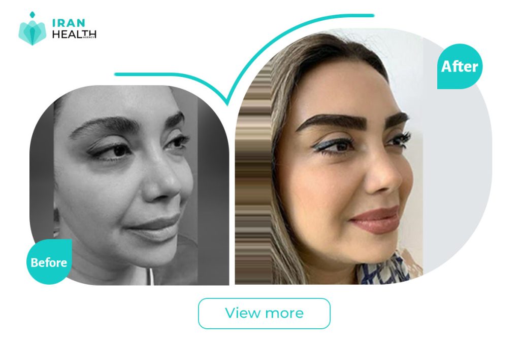 Eyebrow lift in Iran before after photos