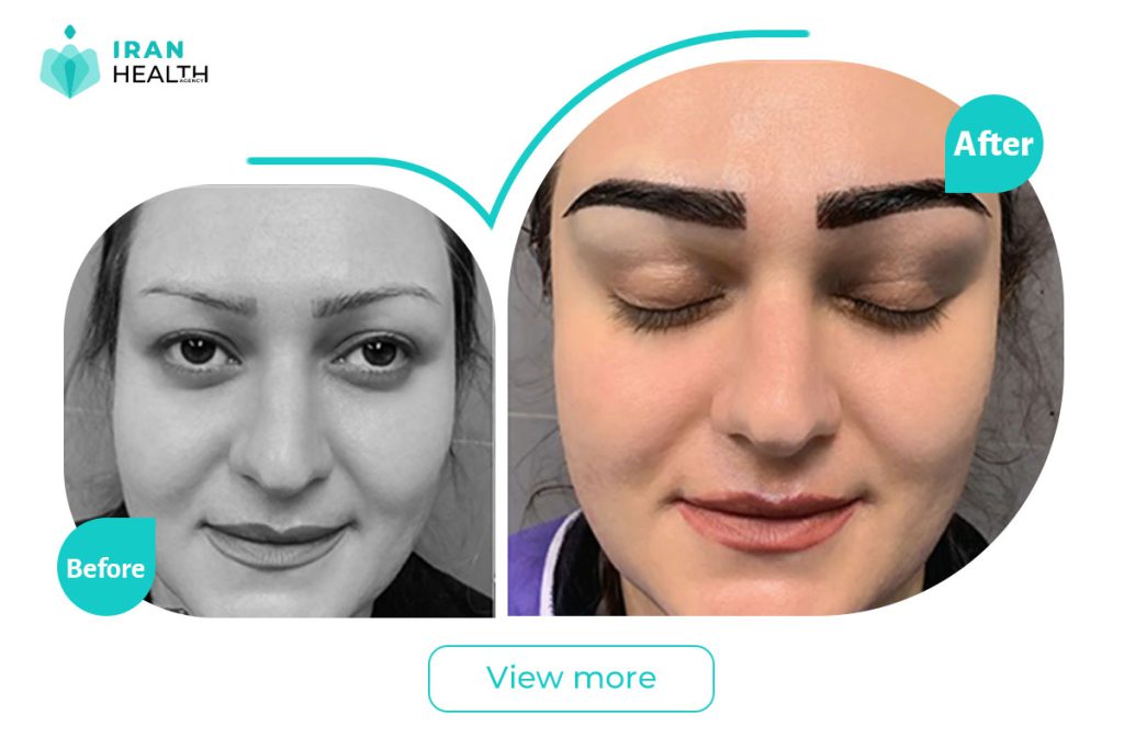 Eyebrow lift in Iran before after photos