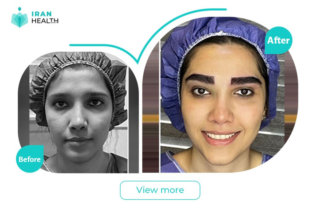 Eyebrows transplant in iran before after photos