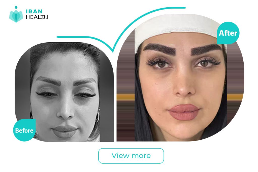 Eyebrows transplant in iran before after photos