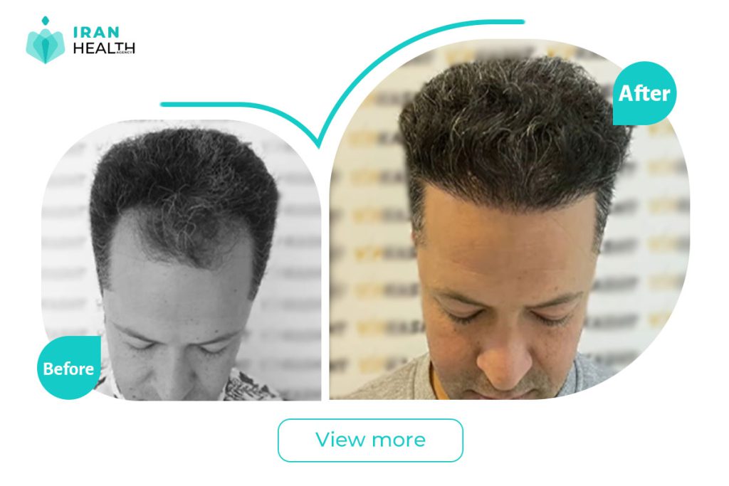 Hair Line in iran before after photos