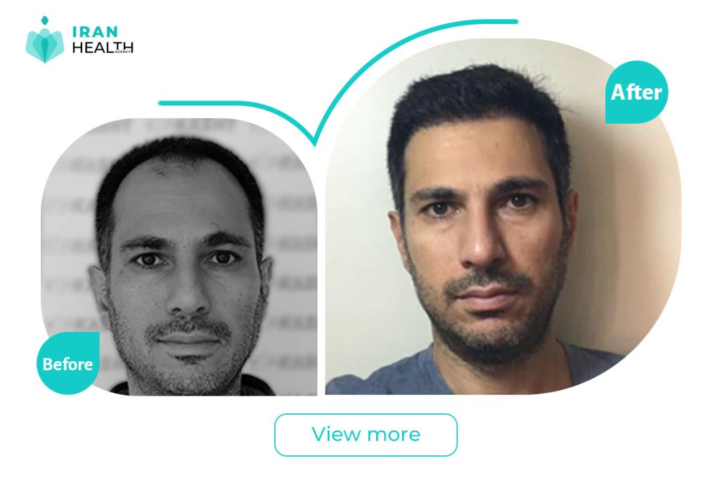 Hair Line in iran before after photos