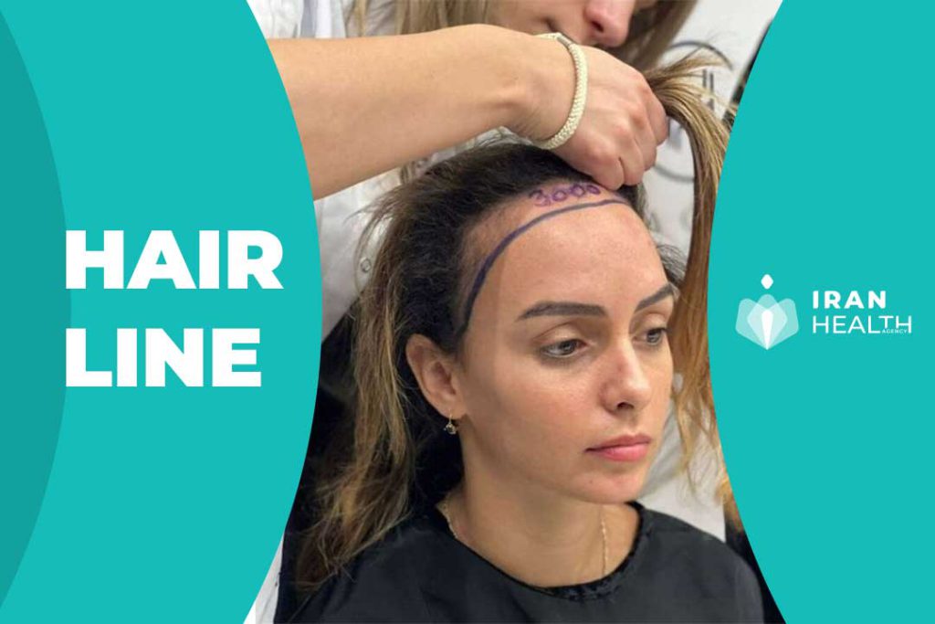 How is the procedure of hairline lowering?