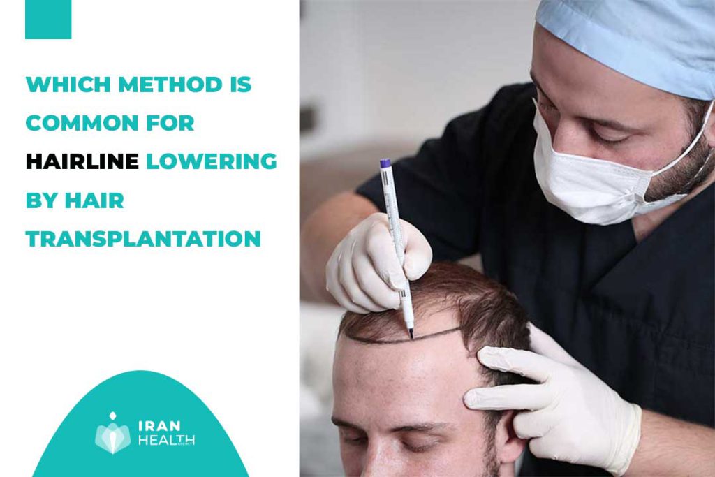 Which method is common for hairline lowering by hair transplantation?