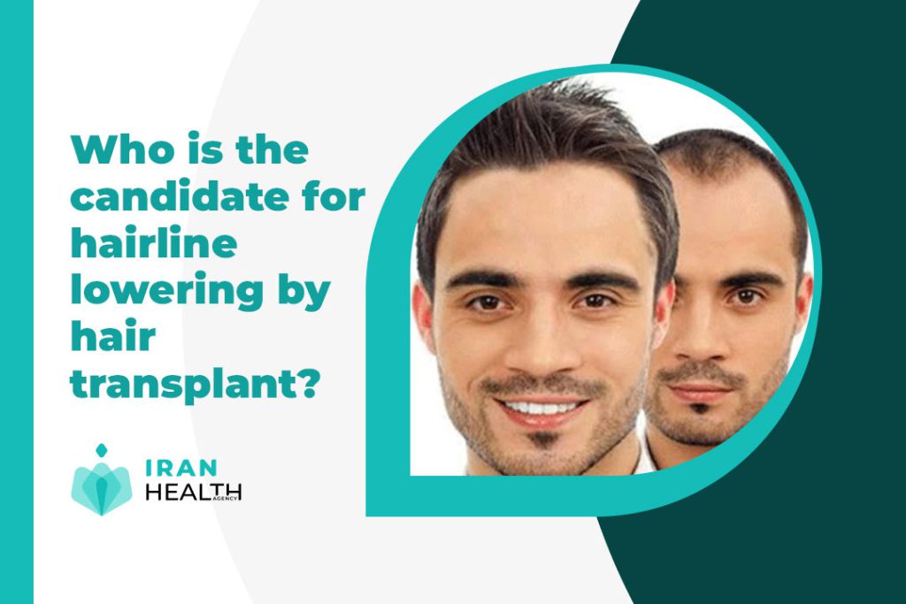 What are advantages of hairline lowering by hair transplant?