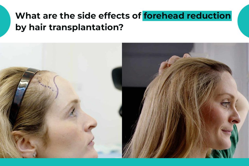 Is hairline lowering by hair transplant permanent?