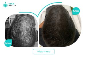 Mesotherapy in iran before after photos