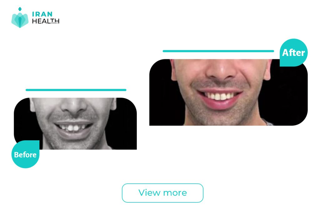 Orthodontics in Iran before after photos