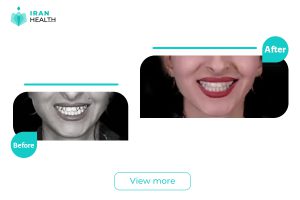 Orthodontics in Iran before after photos