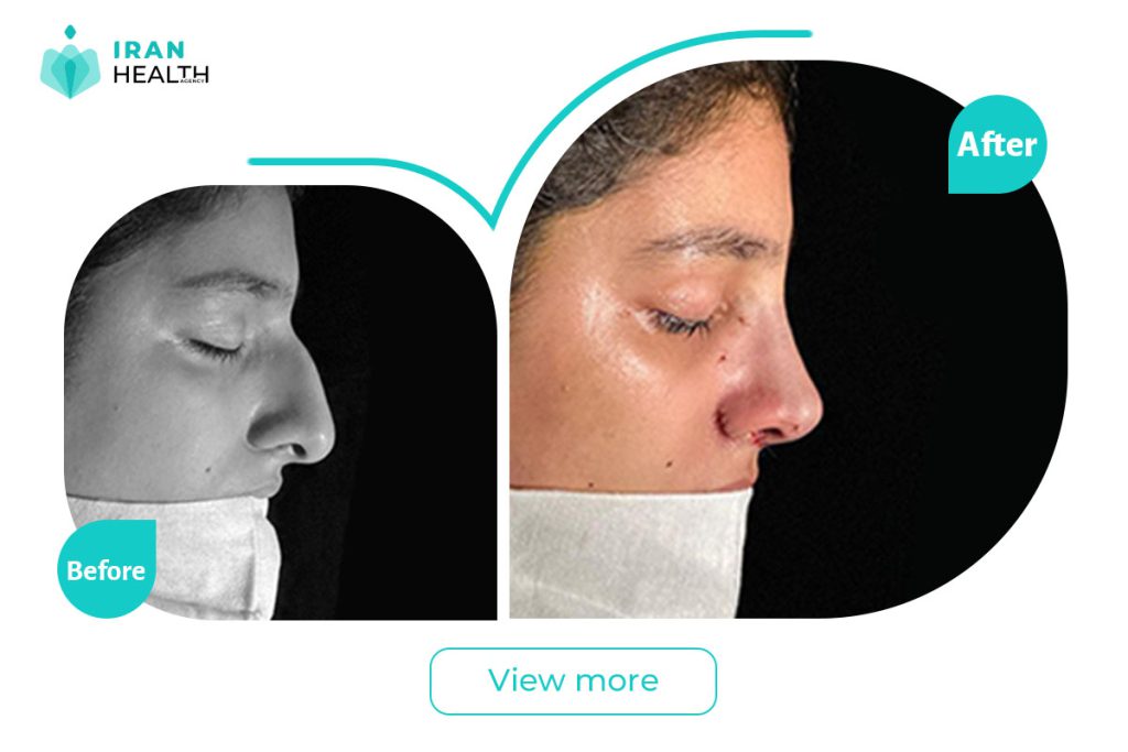 Septoplasty in iran before after photos