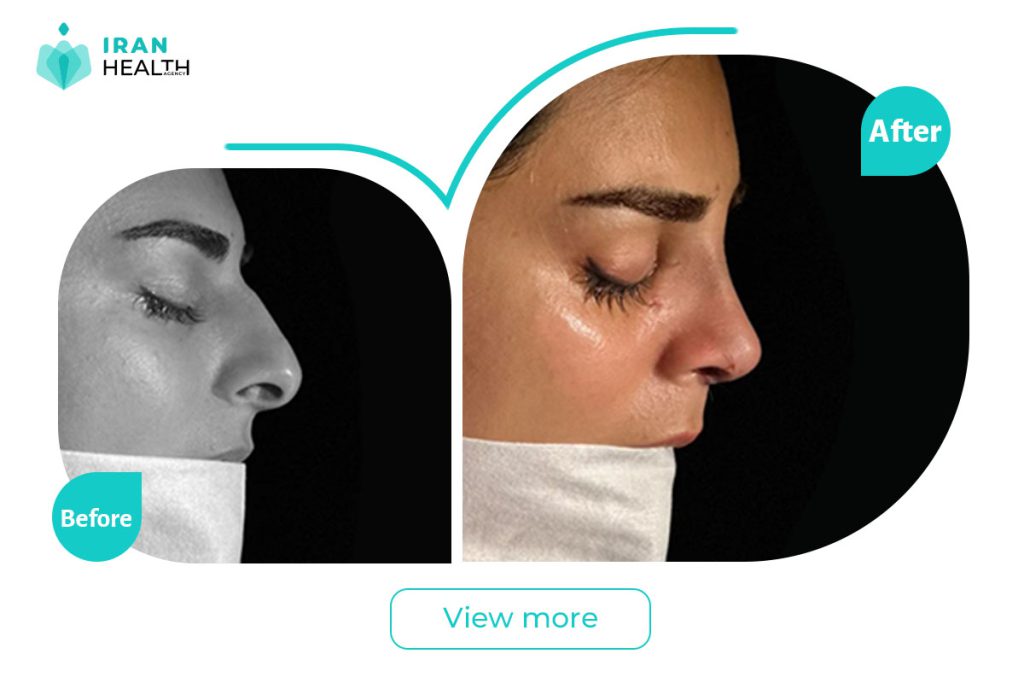 Septoplasty in iran before after photos